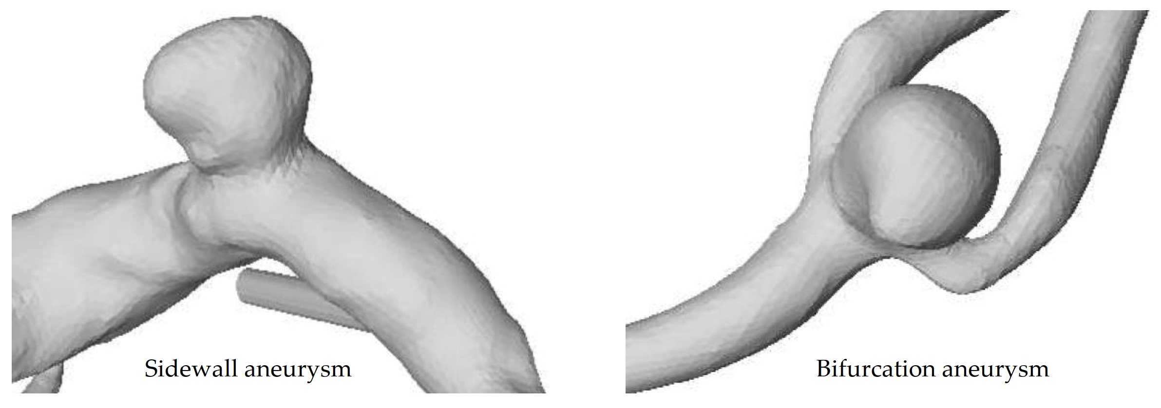 Sidewall and bifurcation aneurysms. Illustration of an aneurysm at the side of the parent vessel wall (left) and an aneurysm at a vessel bifurcation (right). The figure is adapted from [32].